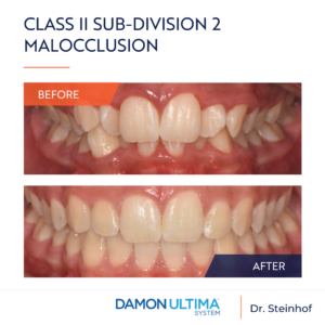 Class II sub-division 2 malocclusion with significant maxillary and mandibular crowding