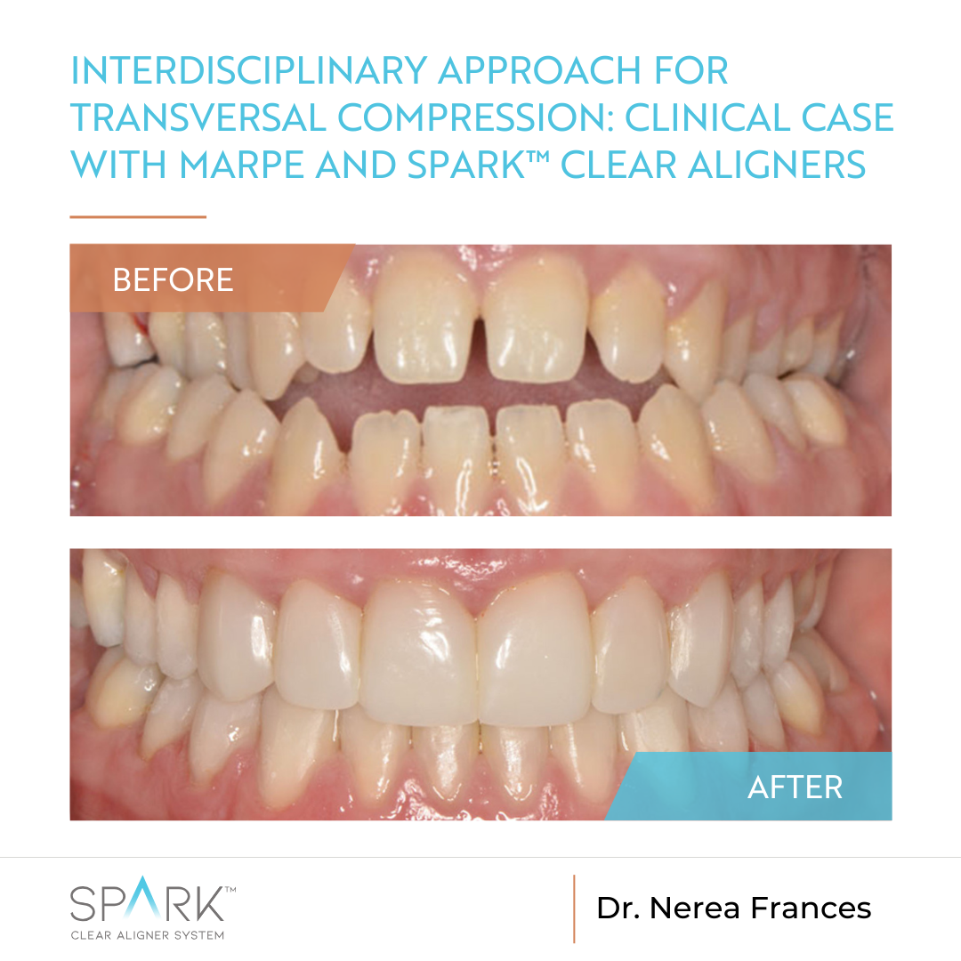 Interdisciplinary approach for transversal compression: Clinical case with MARPE and Spark™ Clear Aligners