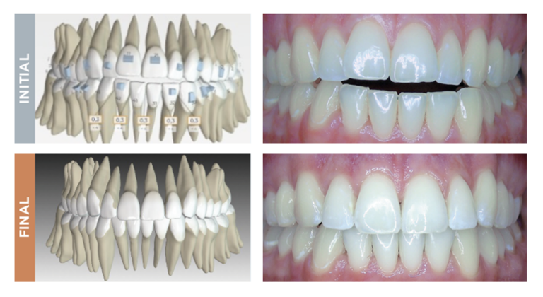 Spark™ - Doctor Site - Innovative & Advanced Aligner System