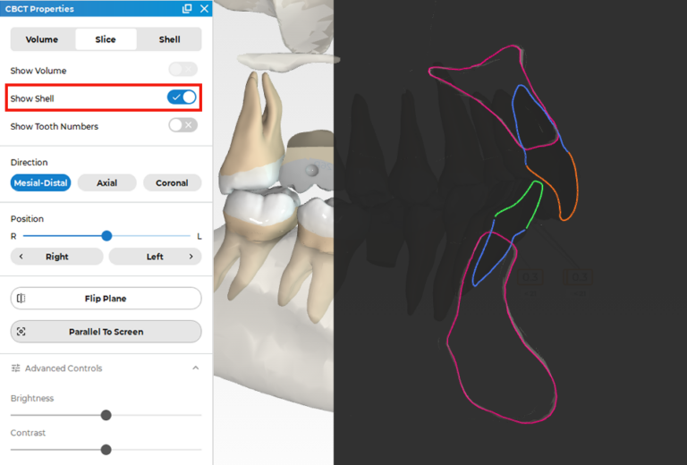 Ormco - Spark™ Releases - Latest Updates on Spark Aligners
