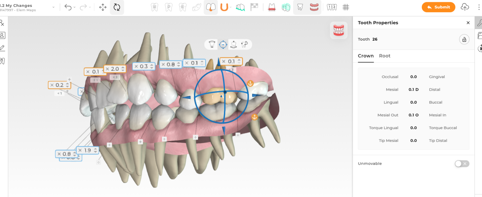 Ormco - Spark™ Releases - Latest Updates on Spark Aligners