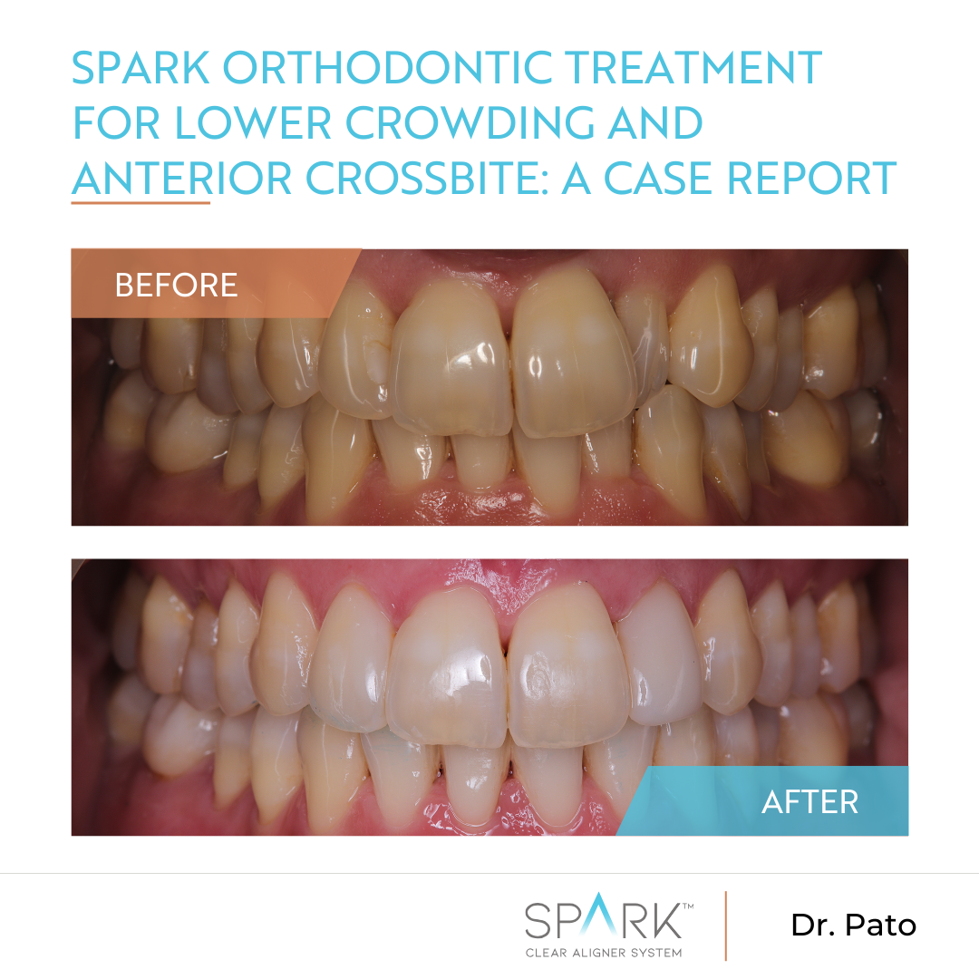 Spark orthodontic treatment for lower crowding and anterior crossbite: a case report