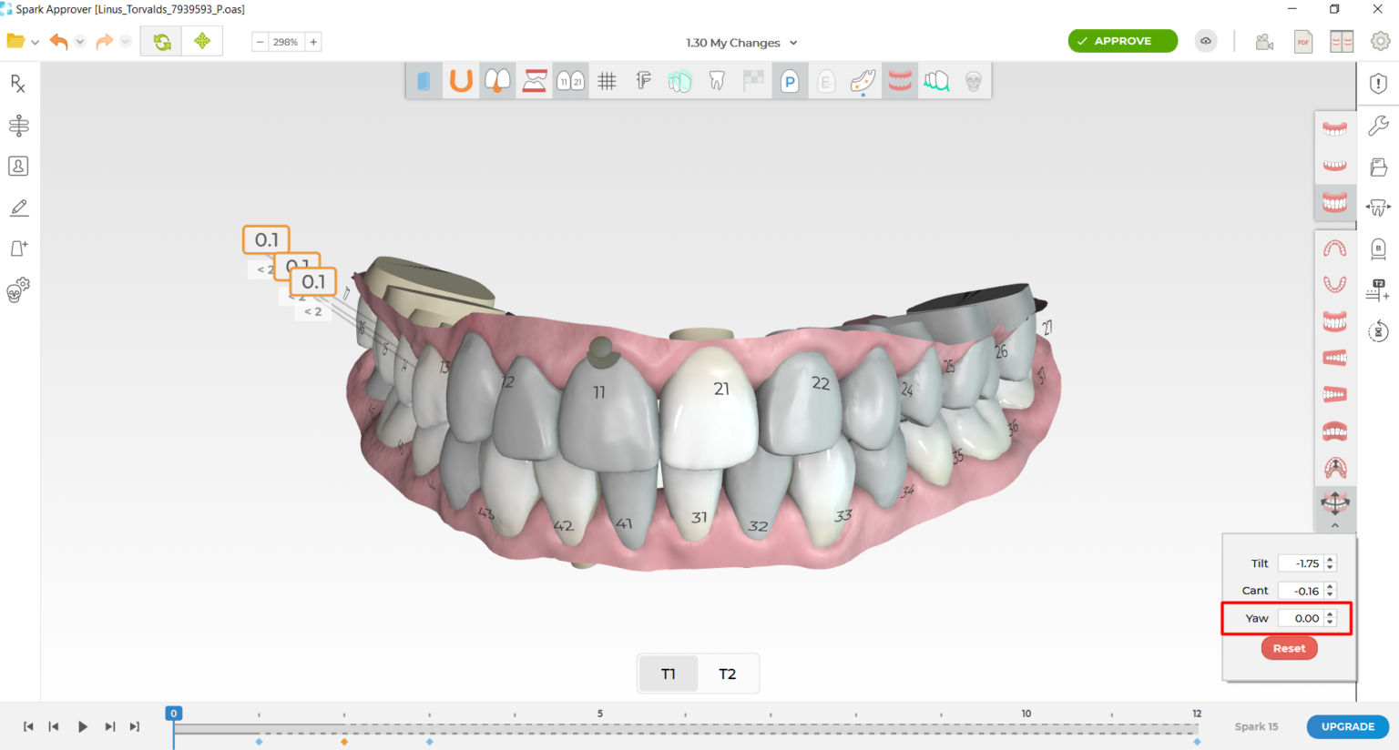 Ormco - Spark™ Releases - Latest Updates on Spark Aligners