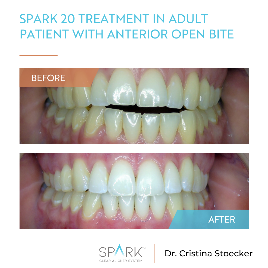 Spark 20 treatment in adult patient with anterior open bite