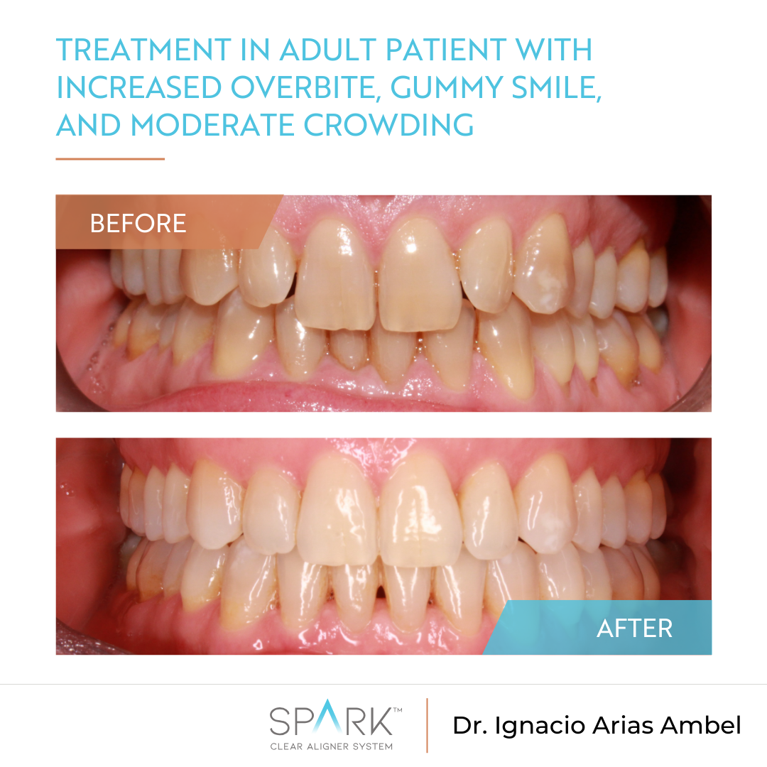 Spark-Treatment in adult patient with increased overbite, gummy smile, and moderate crowding