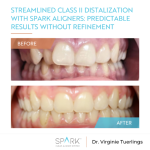 Streamlined Class II distalization with Spark Aligners: Predictable results without refinement