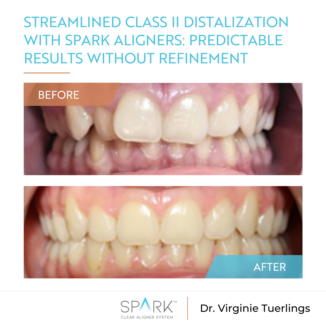 Streamlined Class II distalization with Spark Aligners: Predictable results without refinement