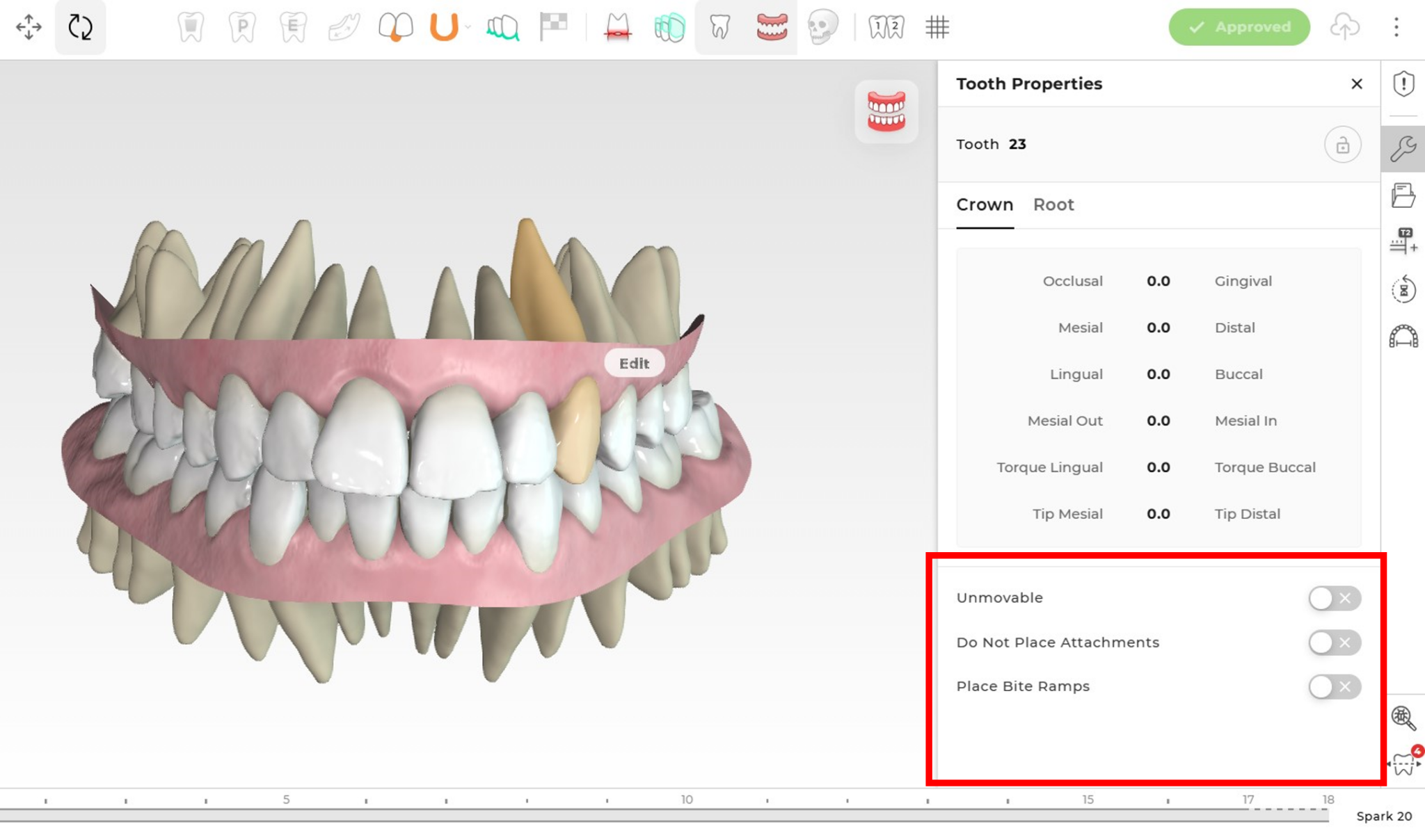 Ormco - Spark™ Releases - Latest Updates on Spark Aligners