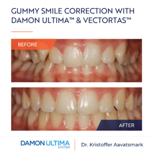 Gummy smile correction with Damon Ultima & VectorTAS