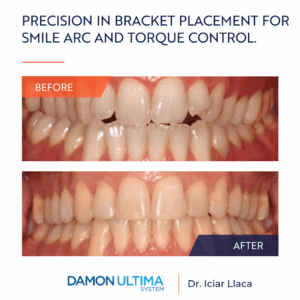 Damon Ultima: Precision in Bracket Placement for Smile Arc and Torque Control.