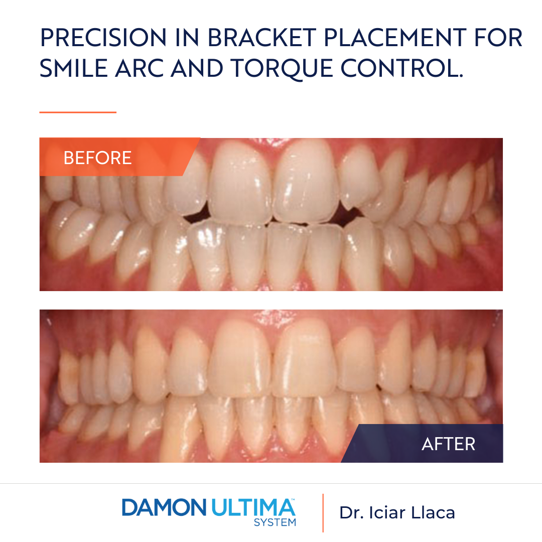 Damon Ultima: Precision in Bracket Placement for Smile Arc and Torque Control.