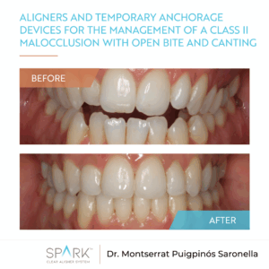 Aligners and temporary anchorage devices for the management of a Class II malocclusion with open bite and canting: A clinical case report