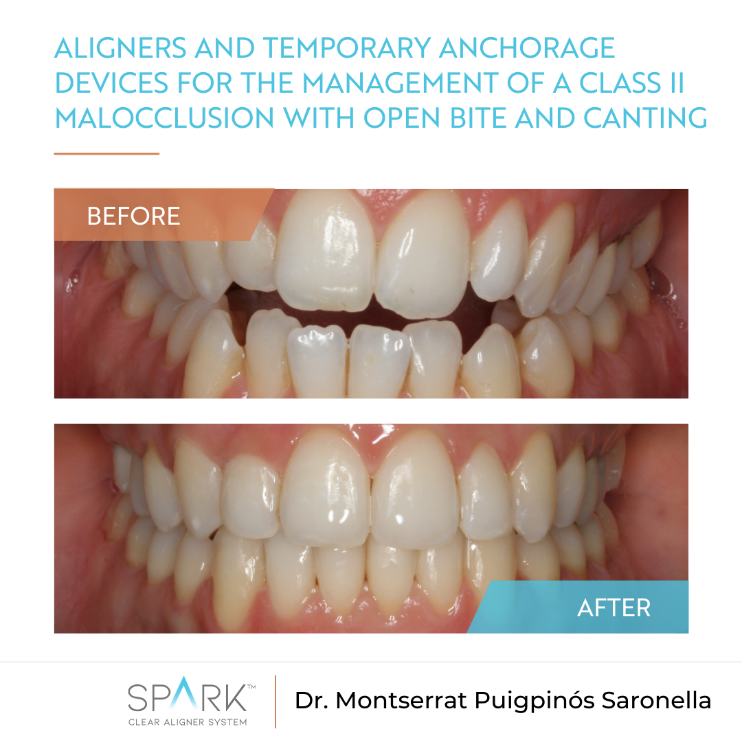 Aligners and temporary anchorage devices for the management of a Class II malocclusion with open bite and canting: A clinical case report
