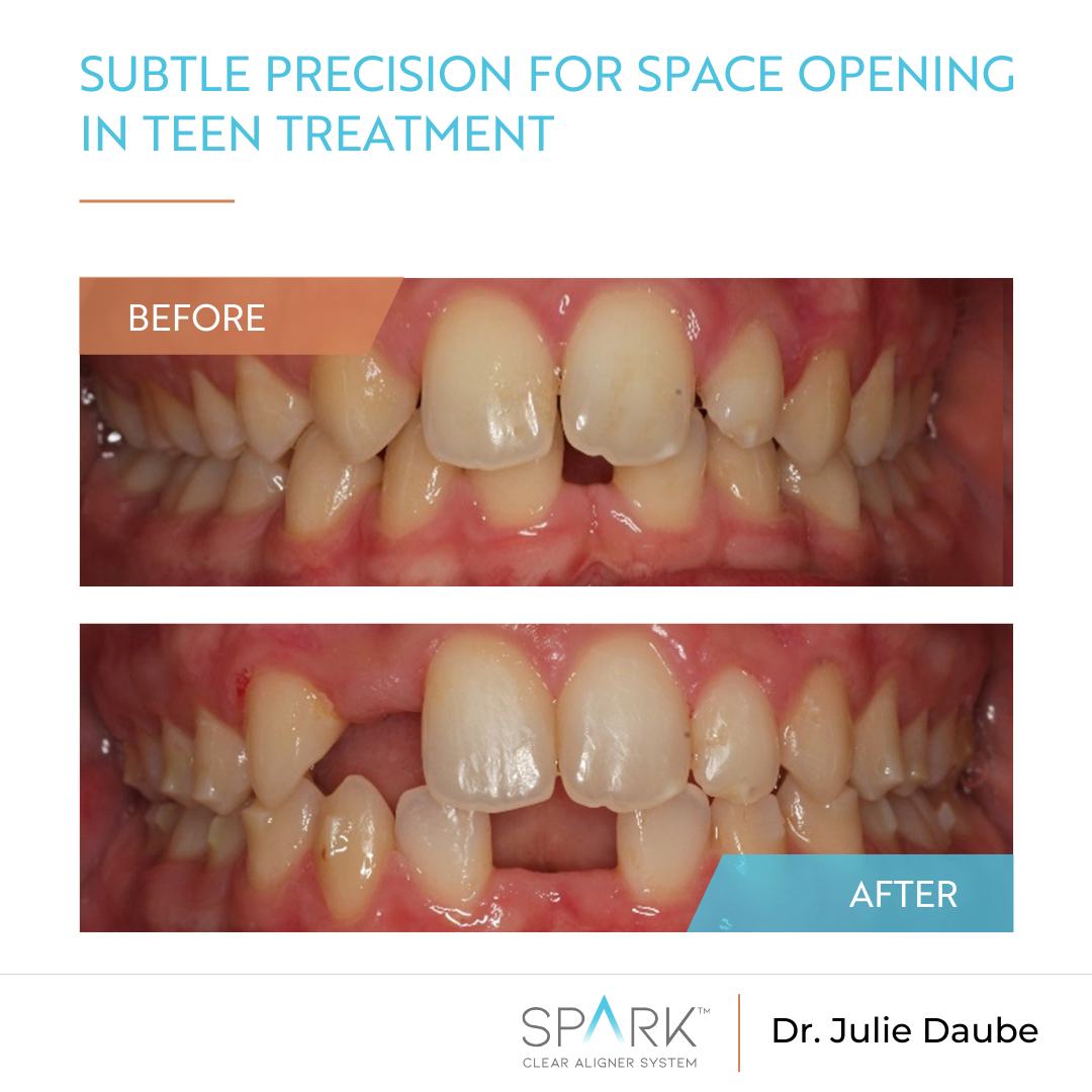 Subtle precision for space opening in teen treatment