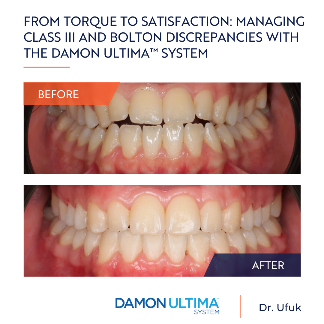 From torque to satisfaction: Managing class III and bolton discrepancies with the Damon Ultima™ System