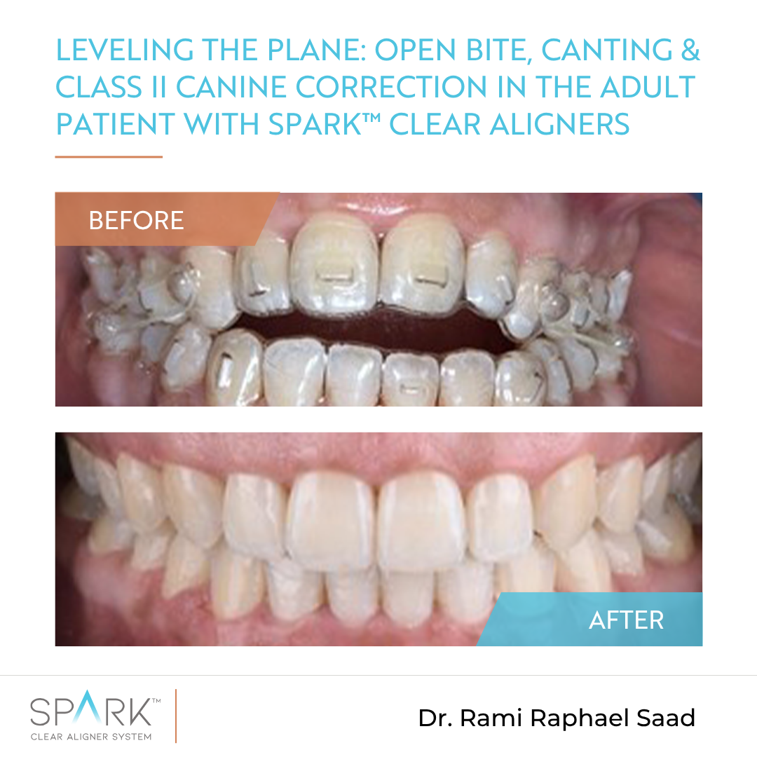 Leveling the plane: Open bite, canting & Class II canine correction in the adult patient with Spark™ Clear Aligners