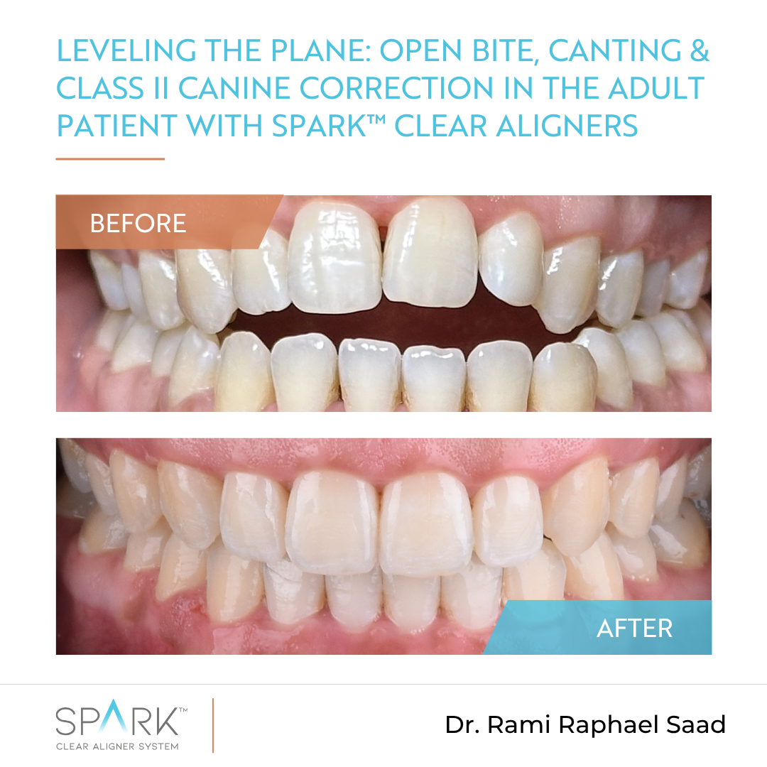 Leveling the plane: Open bite, canting & Class II canine correction in the adult patient with Spark™ Clear Aligners