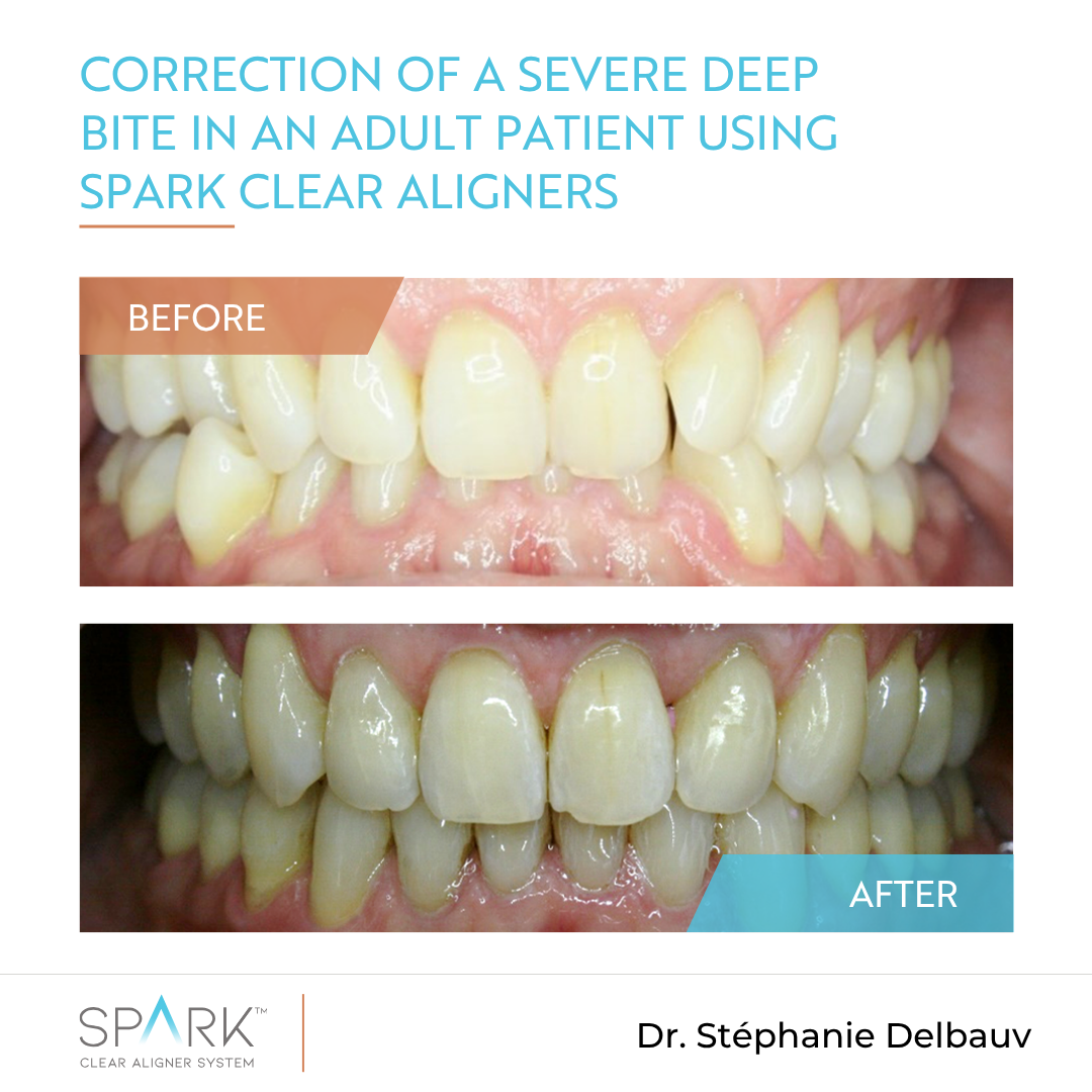 Correction of a severe deep bite in an adult patient using Spark Clear Aligners