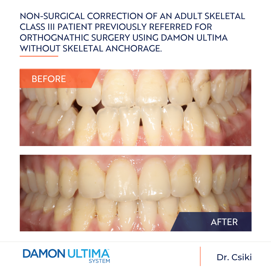 Non-surgical correction of an adult skeletal Class III patient previously referred for orthognathic surgery using Damon Ultima without skeletal anchorage.